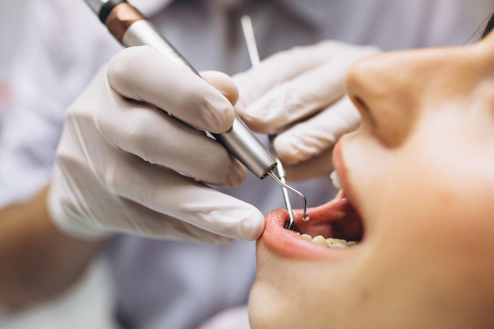 Root canal treatment at The Dental Lounge in Windsor, Ontario